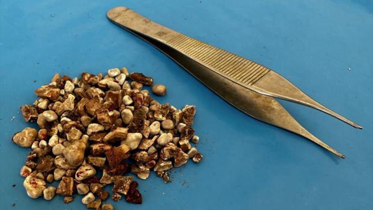 Karın ağrısıyla hastaneye gitmişti! Böbreklerinden 300’den fazla taş çıktı