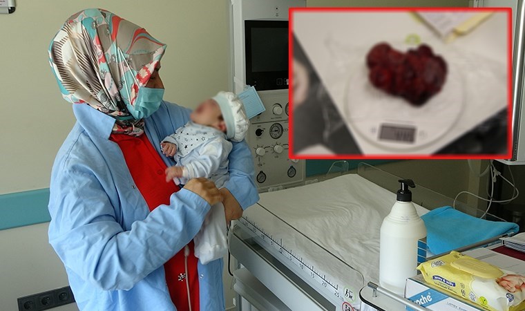 Tıp tarihine geçecek ameliyat: Bebeğin boynundan 445 gram tümör çıkarıldı
